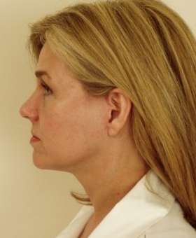 After Image