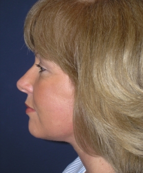 After Image