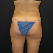 After liposuction images of female from the back