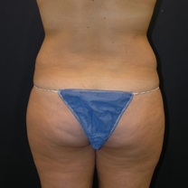 Before liposuction image of female from the back