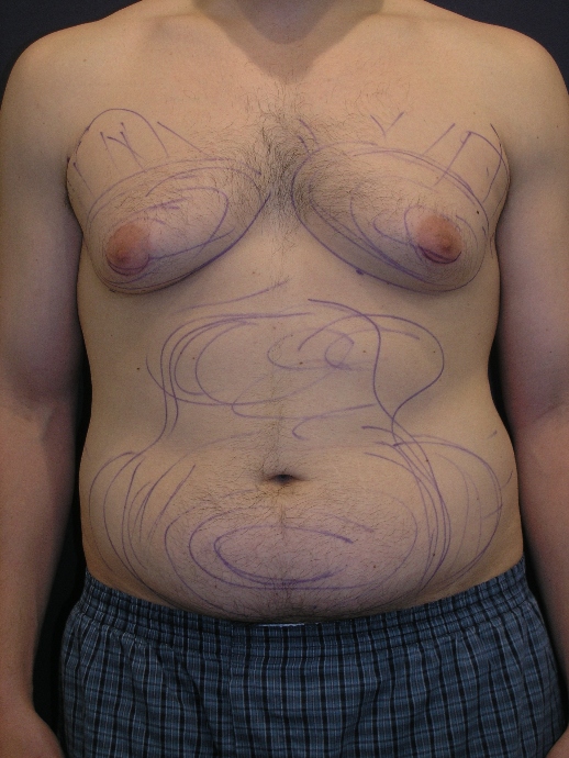 Before liposuction image of a male abdomen