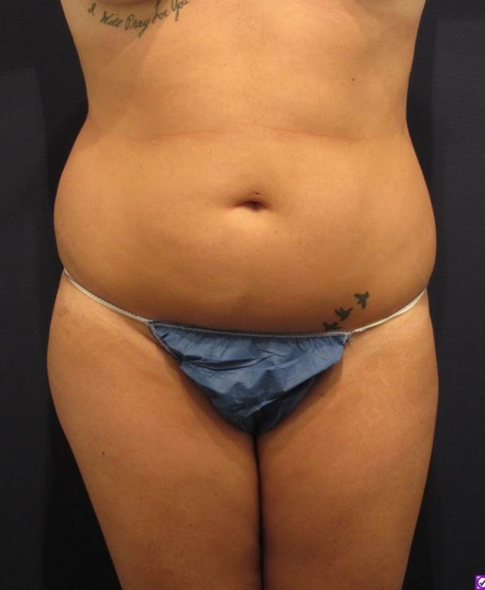 Female stomach before liposuction